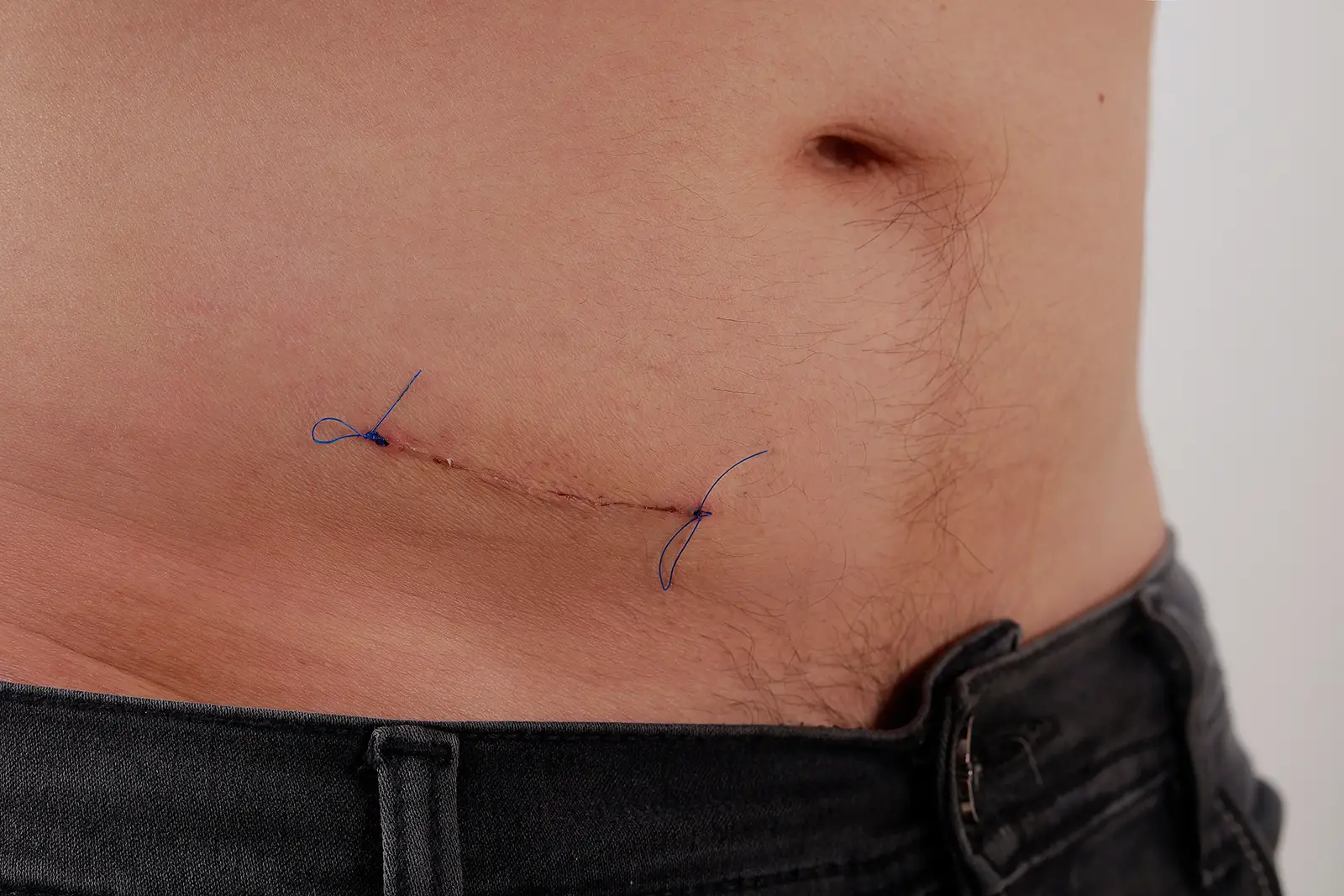 An incision from surgery near the abdomen